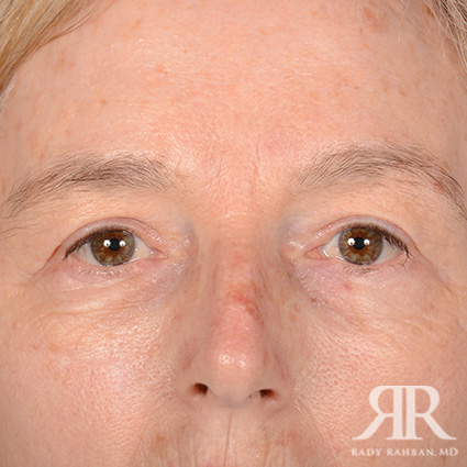 Eyelid Surgery