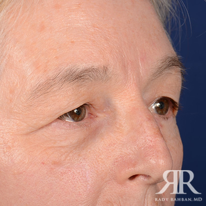 Eyelid Surgery