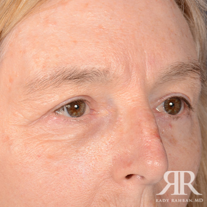 Eyelid Surgery