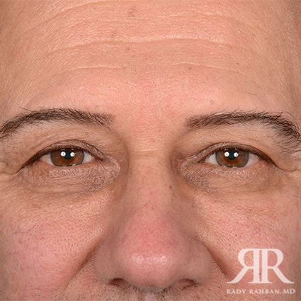 Eyelid Surgery