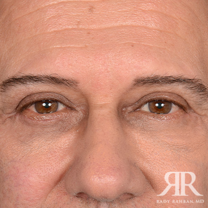 Eyelid surgey results on patient