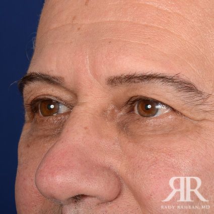 Eyelid Surgery