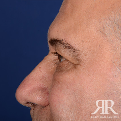 Eyelid Surgery