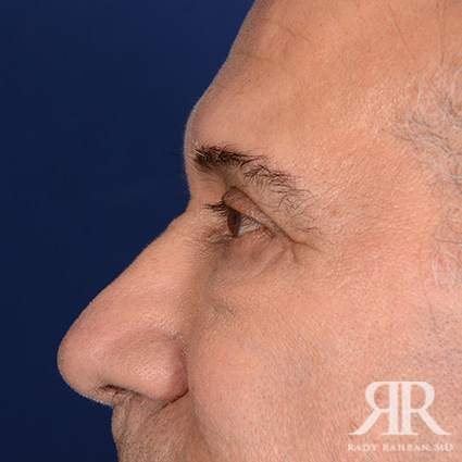 Eyelid Surgery