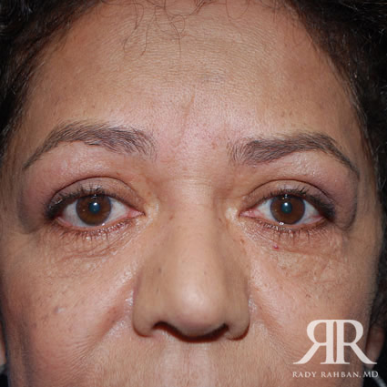 Eyelid surgey results on patient