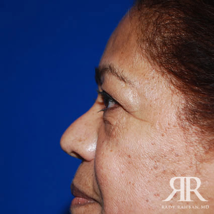 Eyelid Surgery