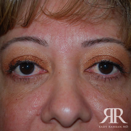 Eyelid Surgery