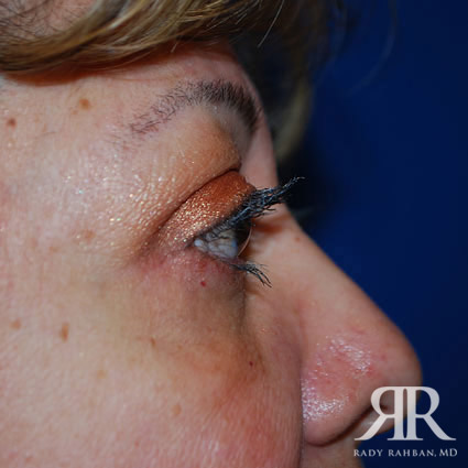 Eyelid Surgery