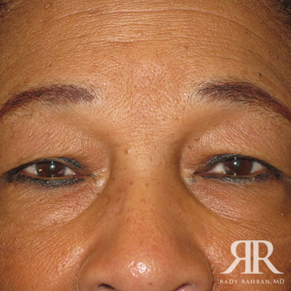 Eyelid Surgery