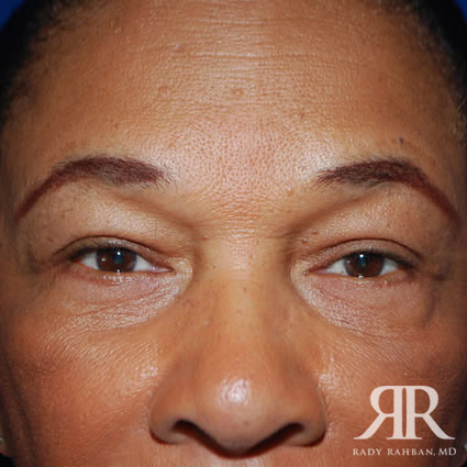 Eyelid Surgery