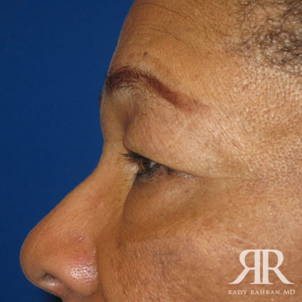 Eyelid Surgery