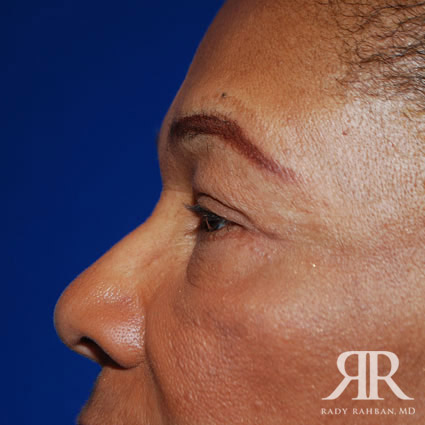 Eyelid Surgery