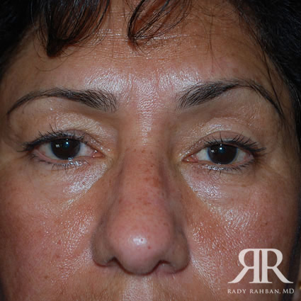 Eyelid Surgery