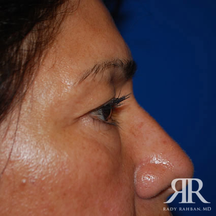 Eyelid Surgery