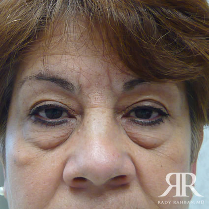 Eyelid Surgery