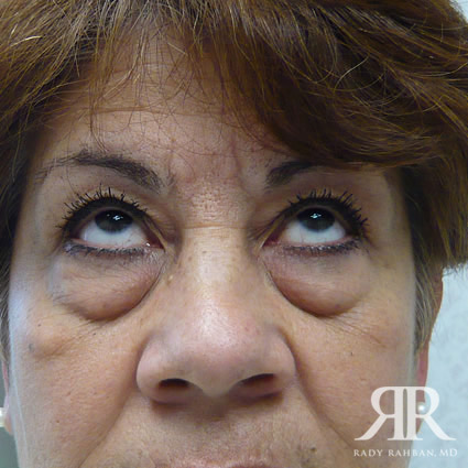 Eyelid Surgery