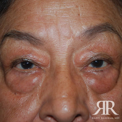 Eyelid Surgery