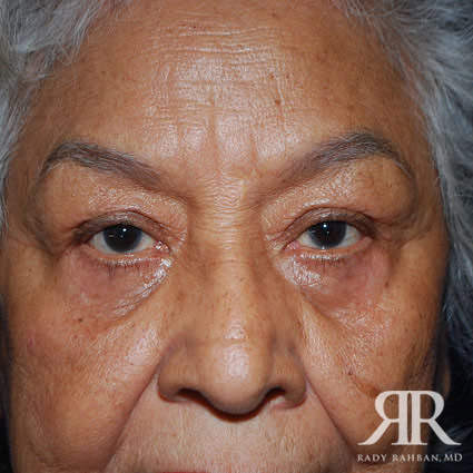 Eyelid Surgery