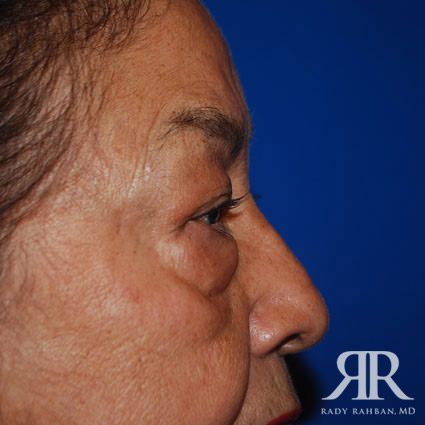 Eyelid Surgery