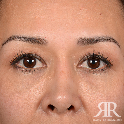 Eyelid Surgery