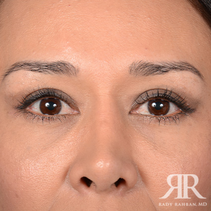 Eyelid Surgery