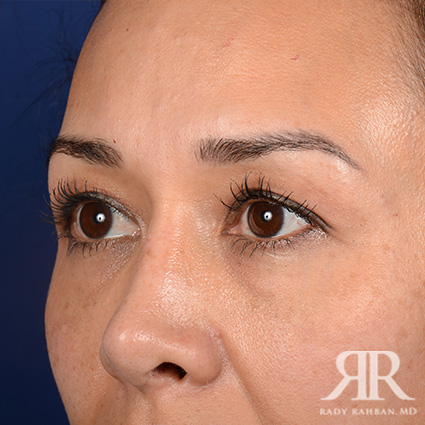 Eyelid Surgery