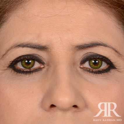 Eyelid Surgery