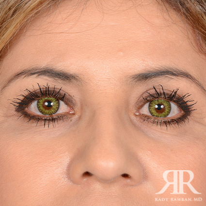 Eyelid Surgery