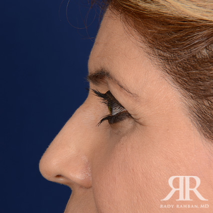 Eyelid Surgery