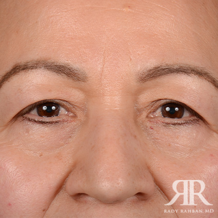 Eyelid Surgery