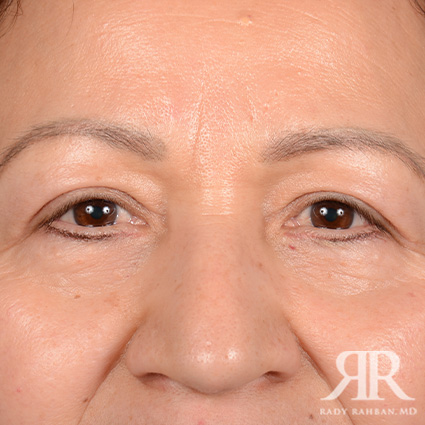 Eyelid Surgery