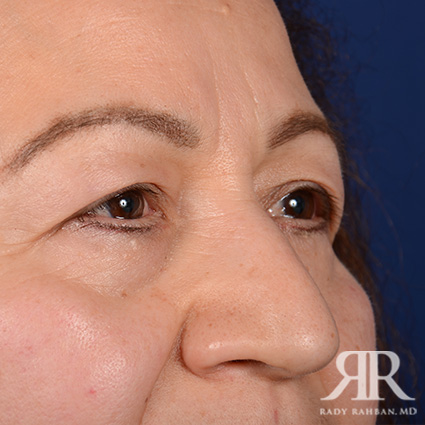 Eyelid Surgery