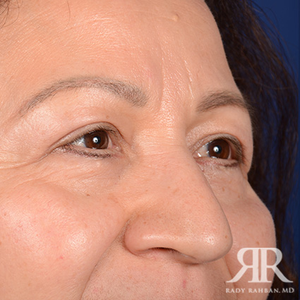 Eyelid Surgery