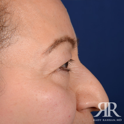 Eyelid Surgery