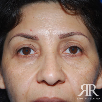 Eyelid Surgery