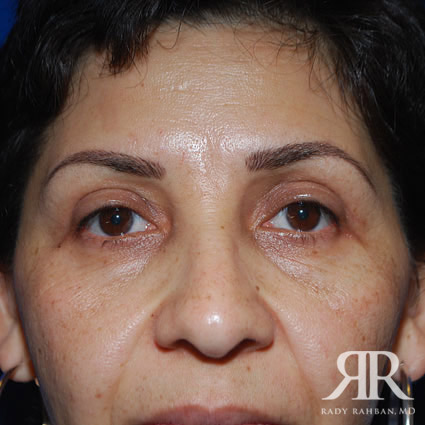 Eyelid Surgery