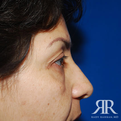 Eyelid Surgery