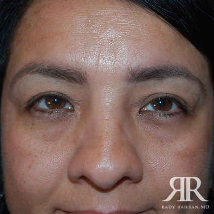 Eyelid Surgery