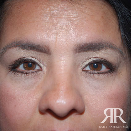 Eyelid Surgery