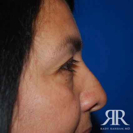 Eyelid Surgery