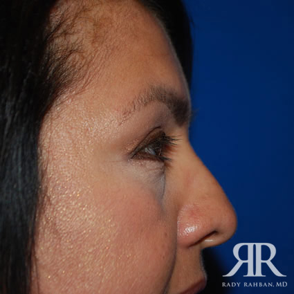 Eyelid Surgery