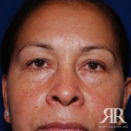 Eyelid Surgery