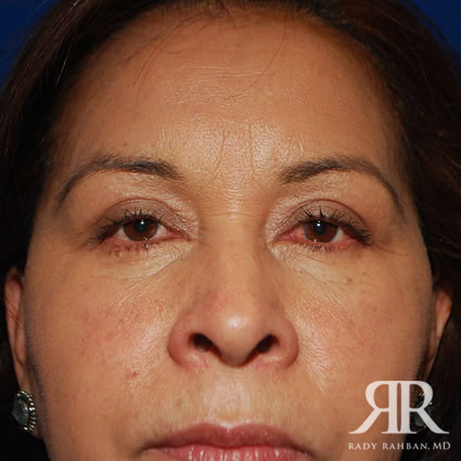 Eyelid Surgery