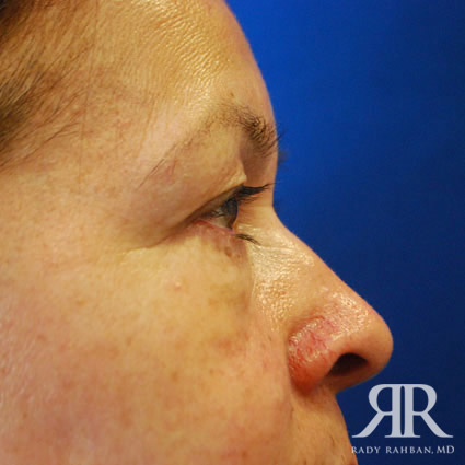 Eyelid Surgery