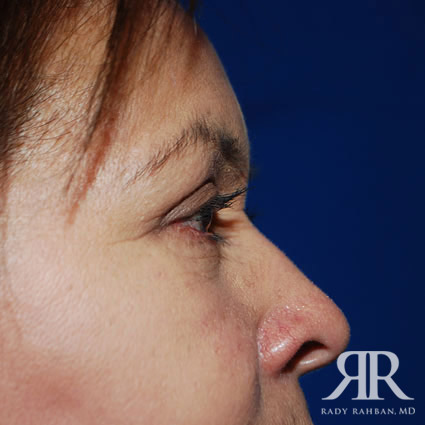 Eyelid Surgery