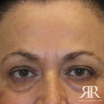 Eyelid Surgery