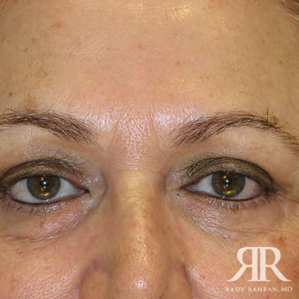 Eyelid Surgery