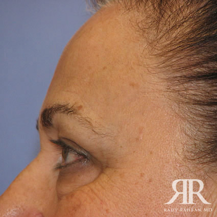 Eyelid Surgery