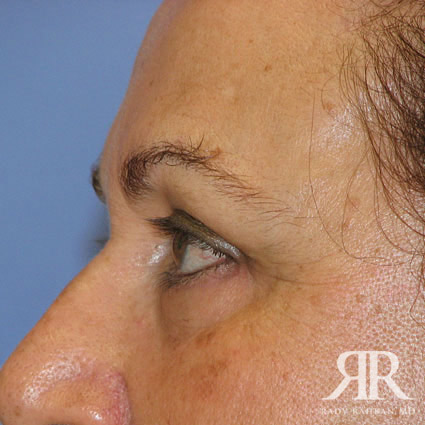 Eyelid Surgery