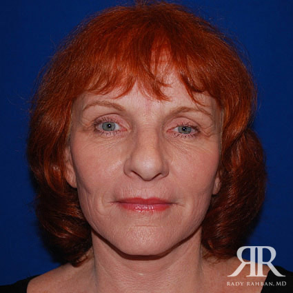 Facelift results on patient